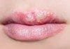 Coconut Oil Post Cold Sores Remedy