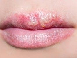 Coconut Oil Post Cold Sores Remedy