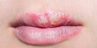Coconut Oil Post Cold Sores Remedy