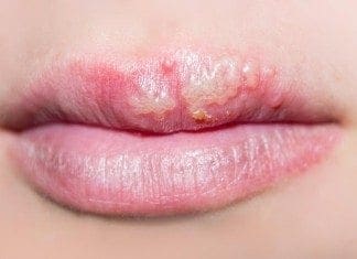 Coconut Oil Post Cold Sores Remedy