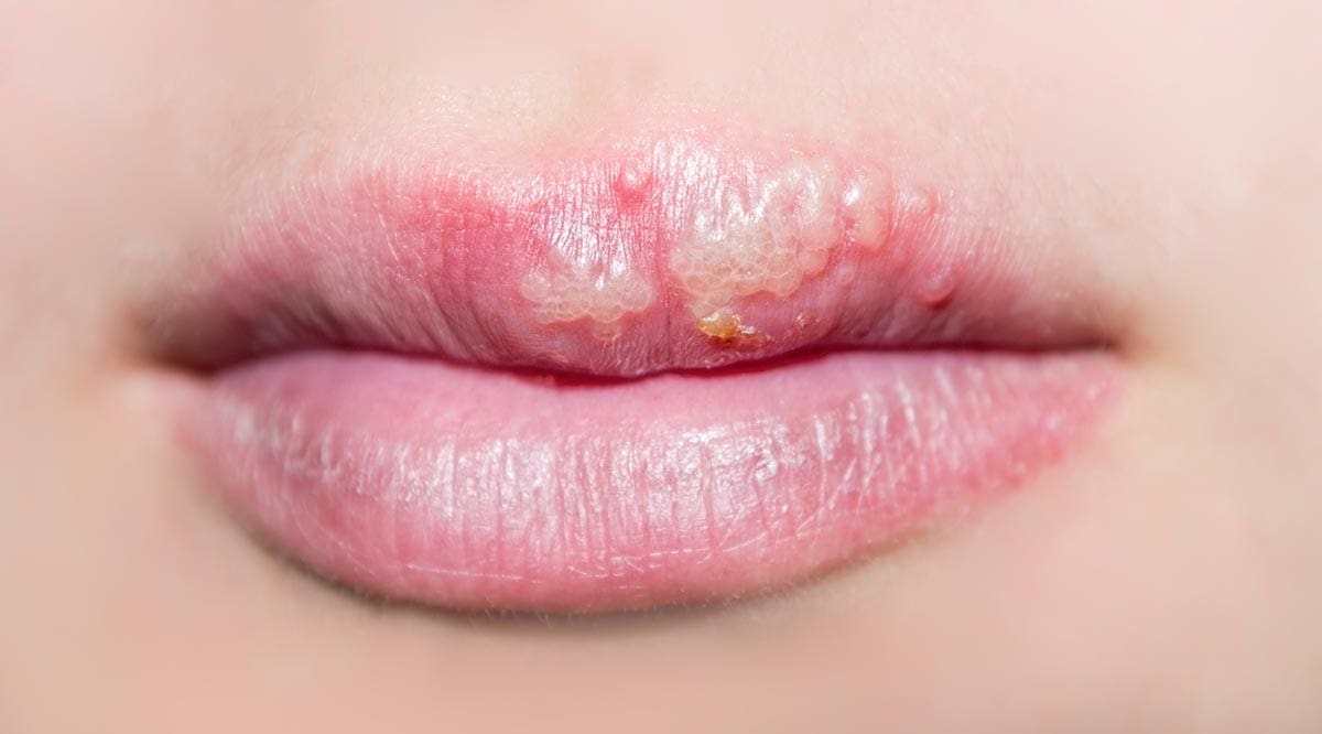 Coconut Oil Post Cold Sores Remedy