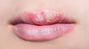 coconut-oil-post-cold-sores-web
