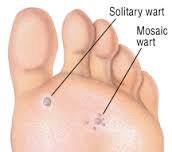 Coconut oil post natural wart removal